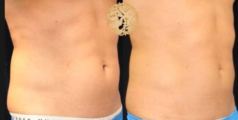 Abdomen Coolsculpting Before & After