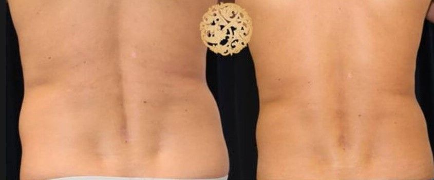 Abdomen Coolsculpting Before & After