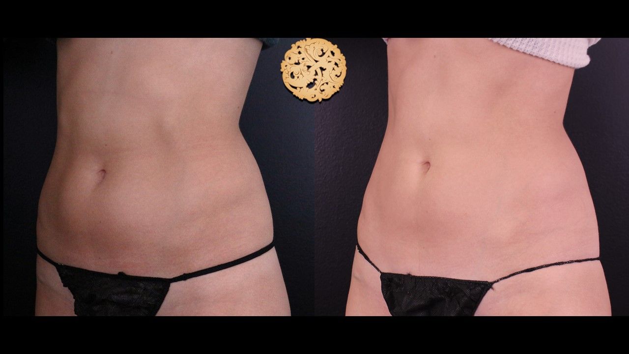 Abdomen Coolsculpting Before & After