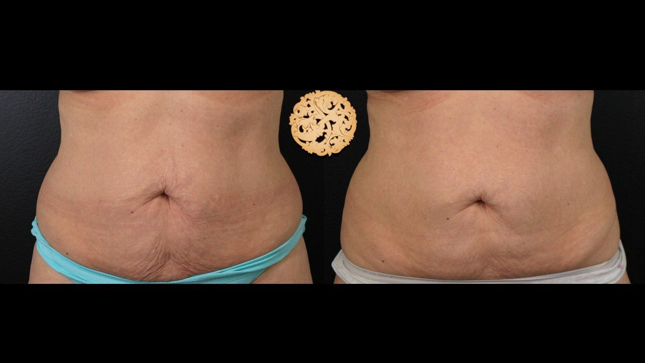 Abdomen Coolsculpting Before & After