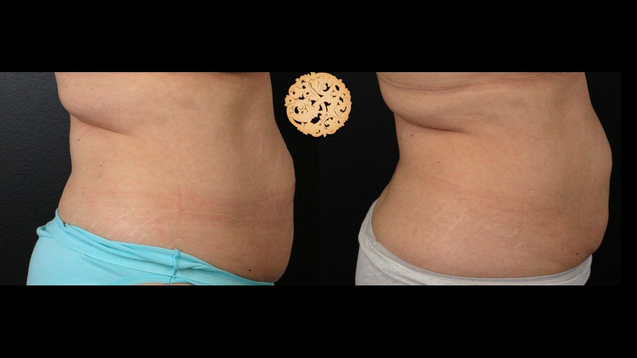 Abdomen Coolsculpting Before & After