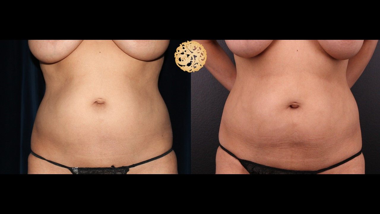 Abdomen Coolsculpting Before & After