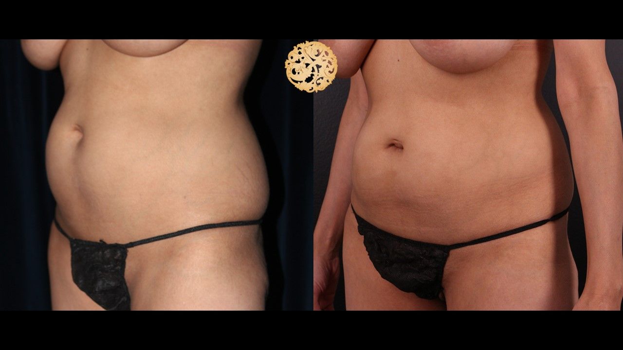 Abdomen Coolsculpting Before & After
