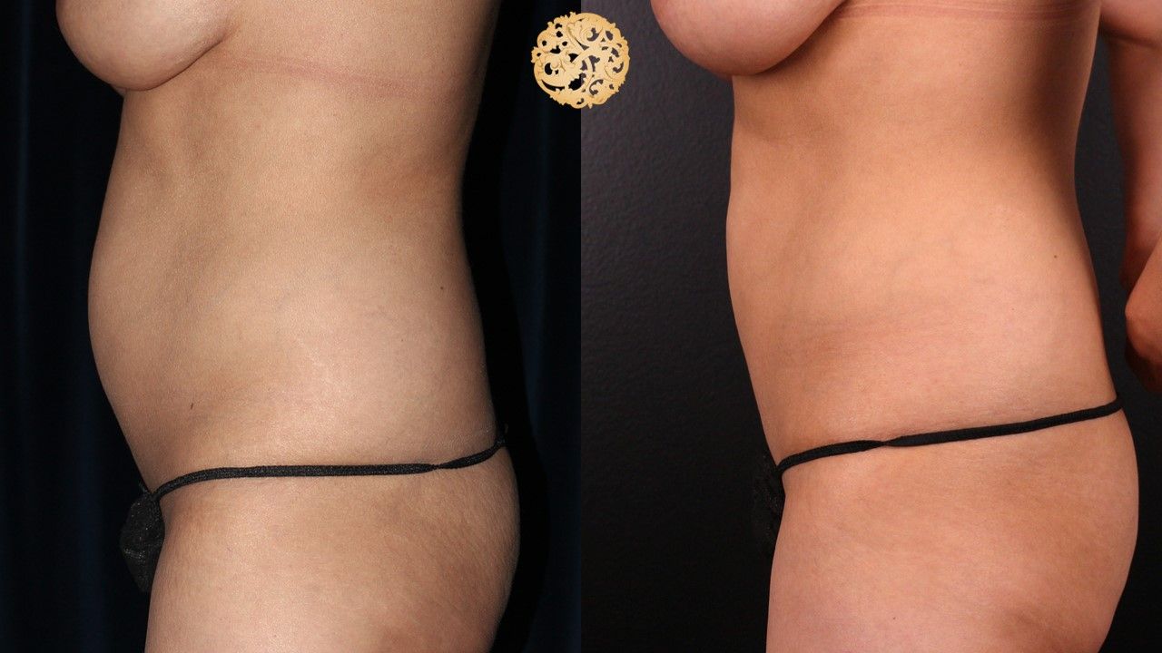 Abdomen Coolsculpting Before & After