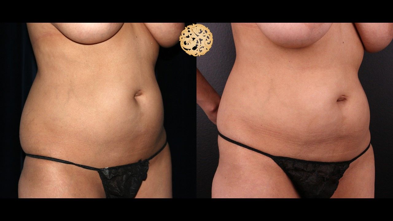 Abdomen Coolsculpting Before & After