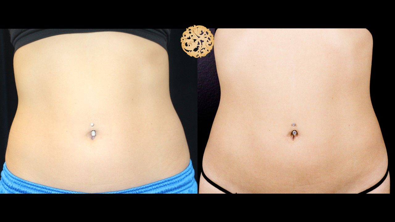 Abdomen Coolsculpting Before & After