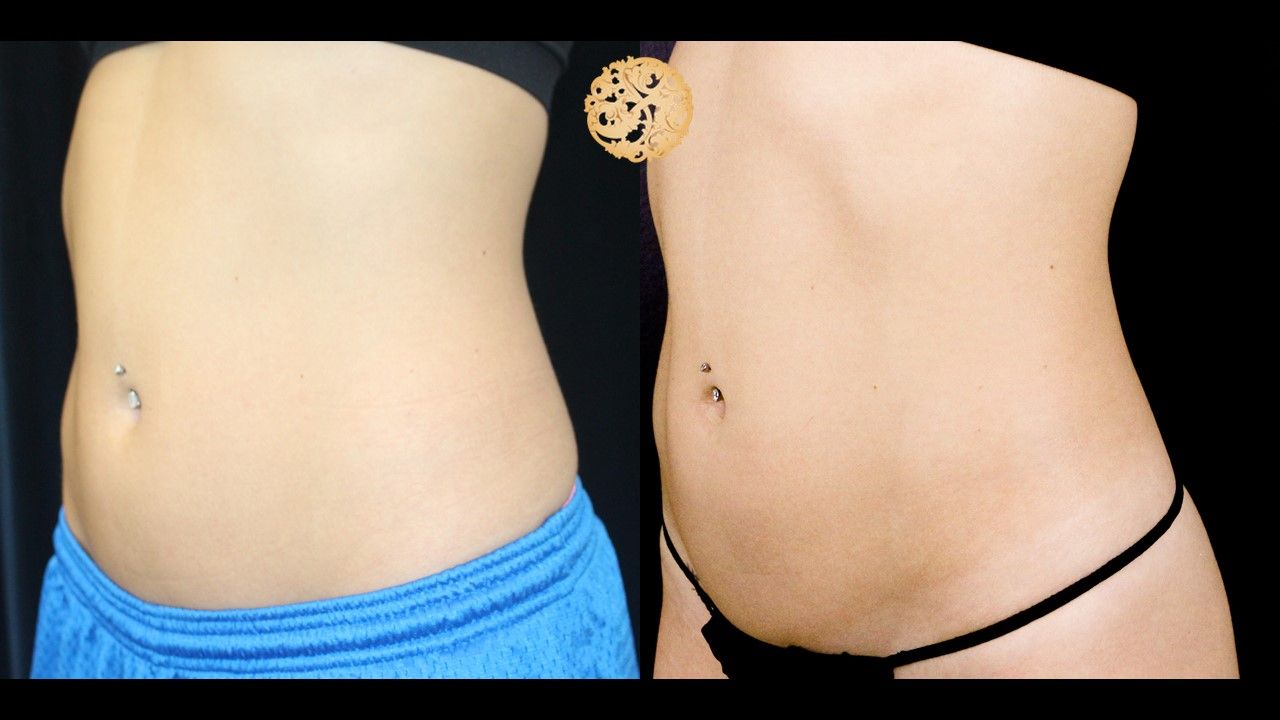 Abdomen Coolsculpting Before & After