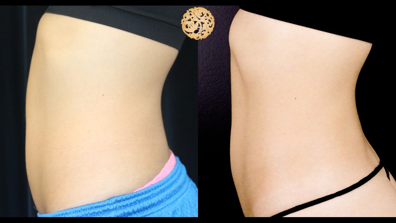 Abdomen Coolsculpting Before & After