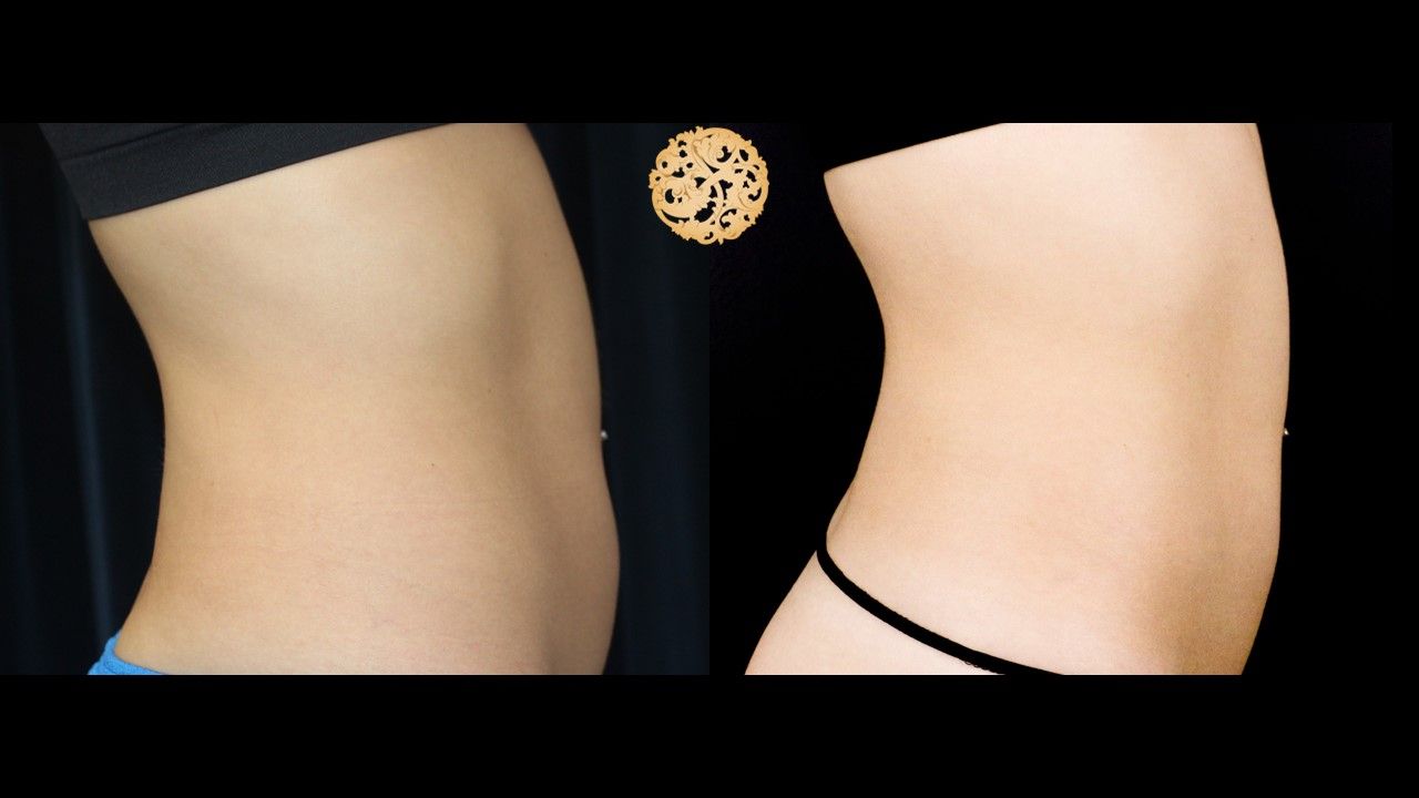 Abdomen Coolsculpting Before & After