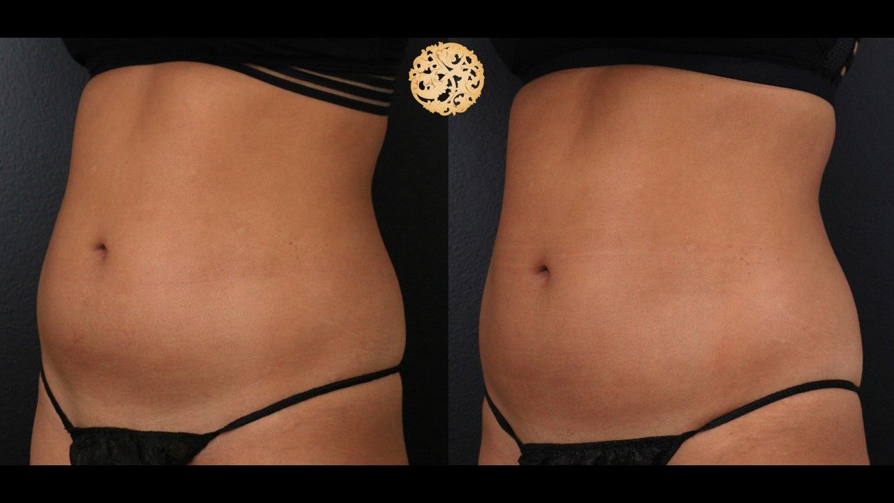 Abdomen Coolsculpting Before & After
