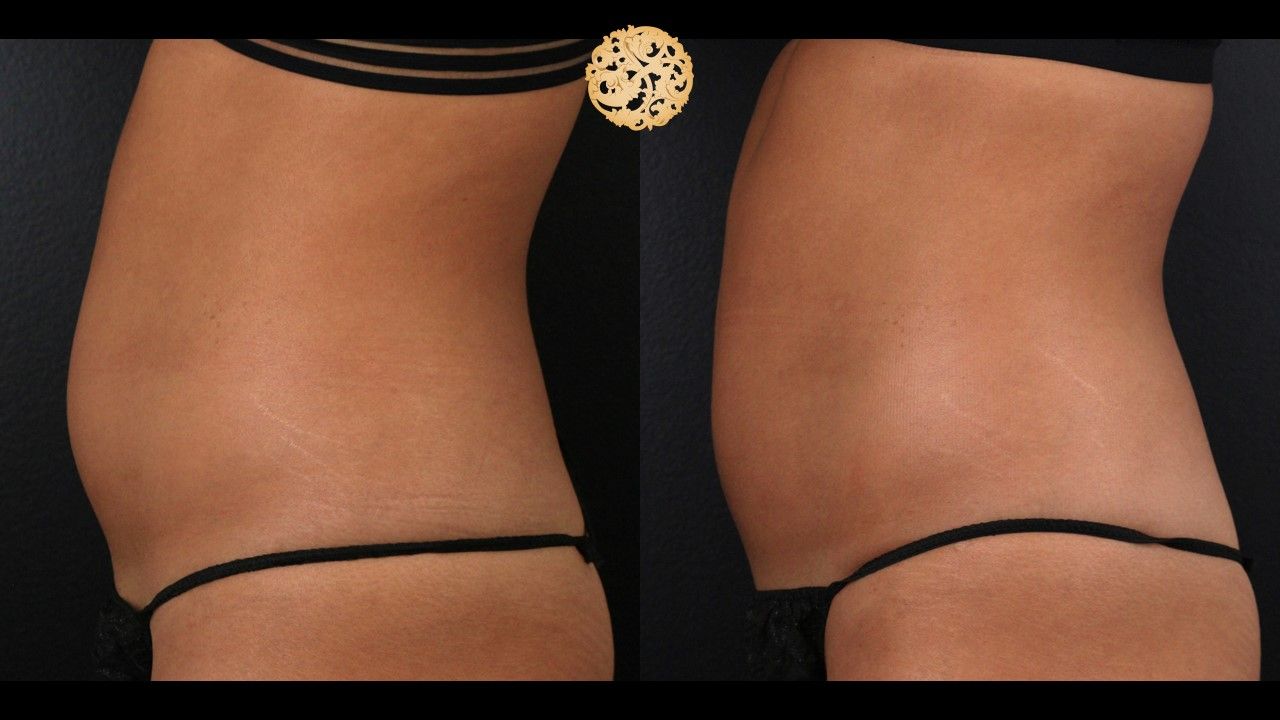 Abdomen Coolsculpting Before & After
