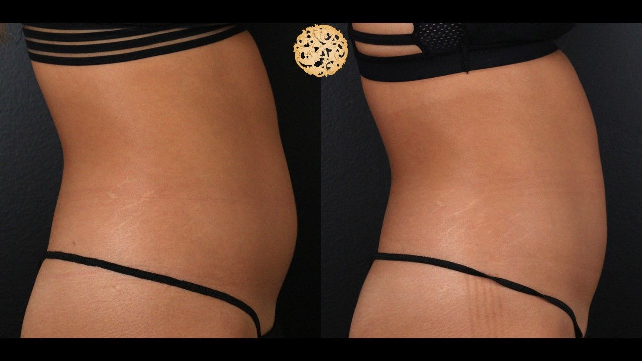 Abdomen Coolsculpting Before & After