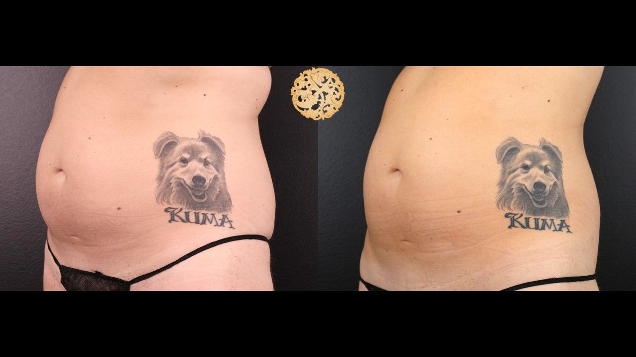 Abdomen Coolsculpting Before & After