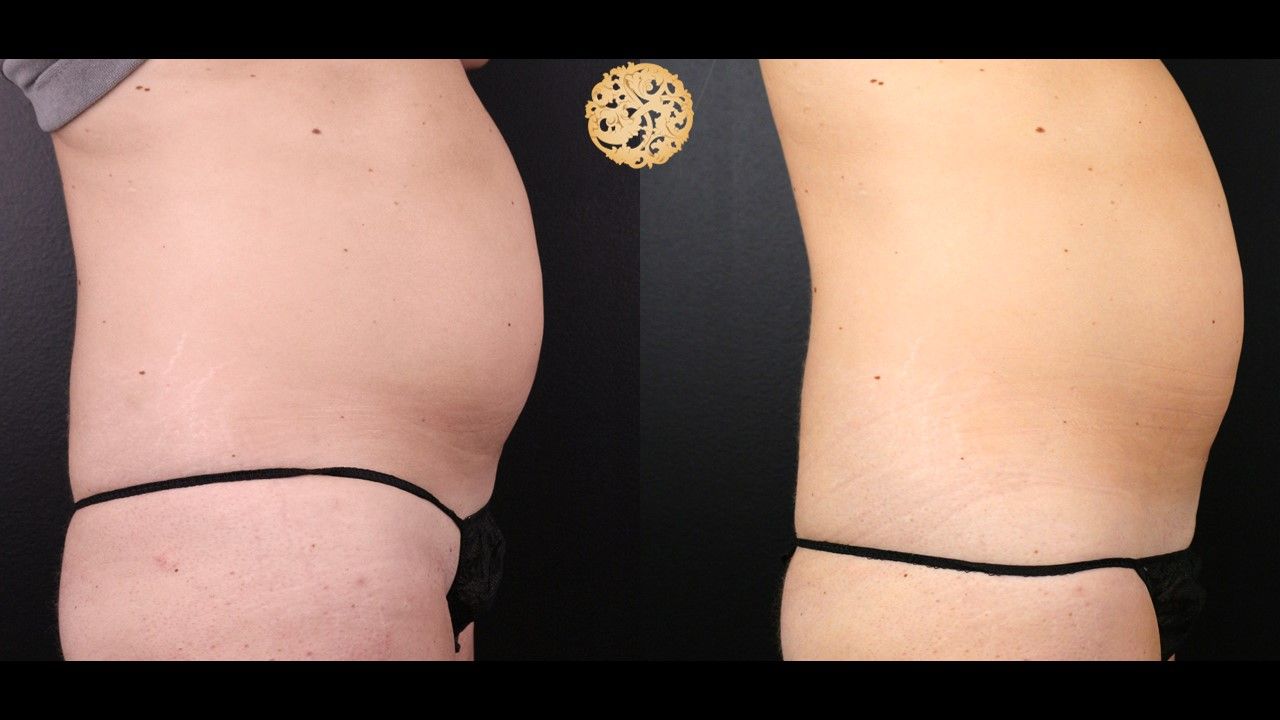 Abdomen Coolsculpting Before & After