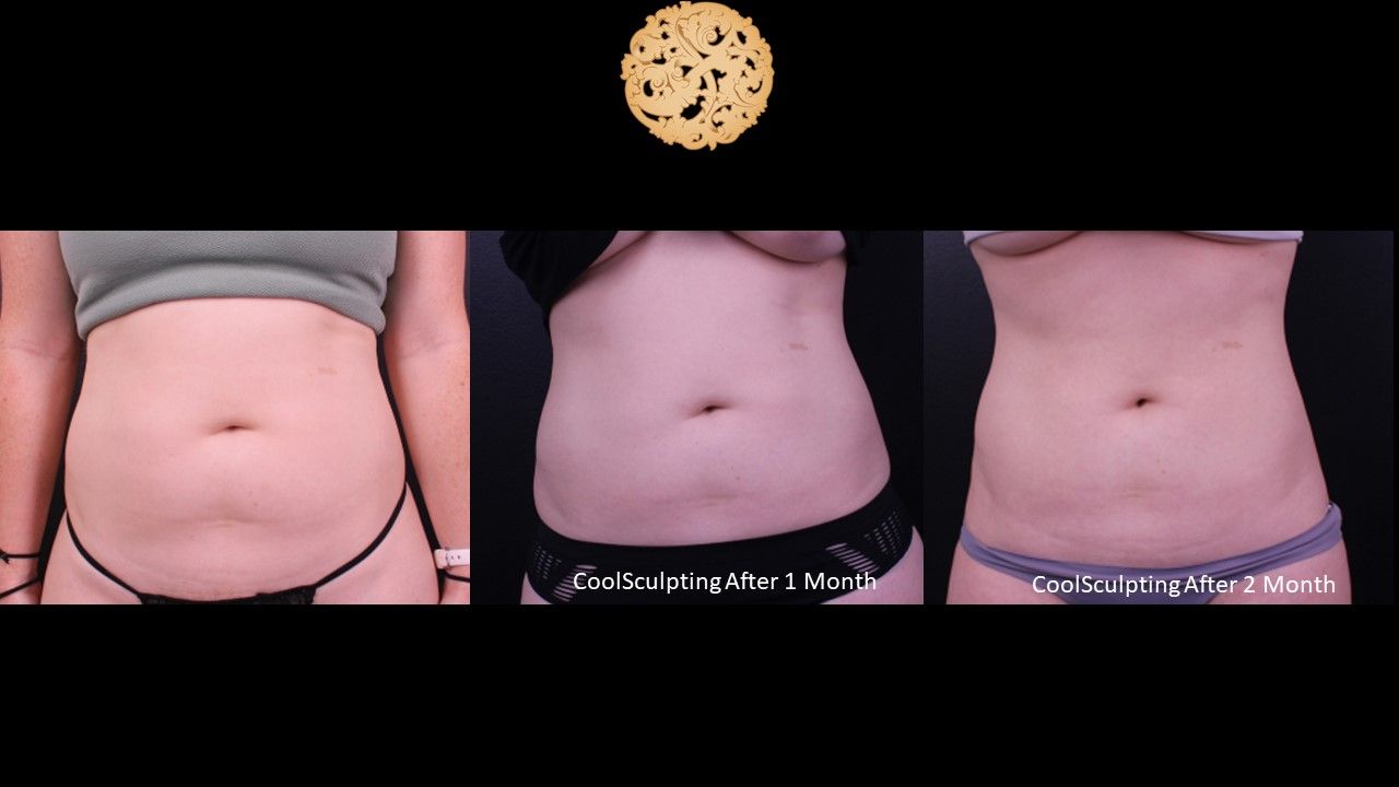Abdomen Coolsculpting Before & After