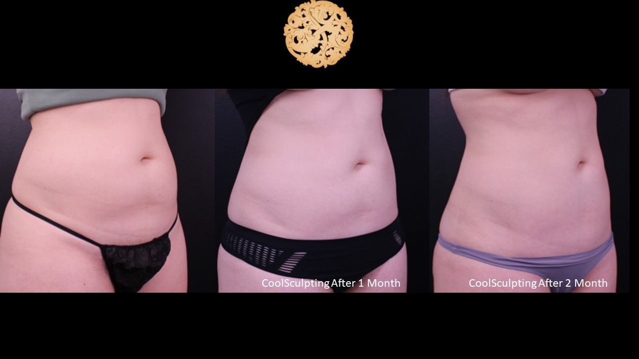 Abdomen Coolsculpting Before & After