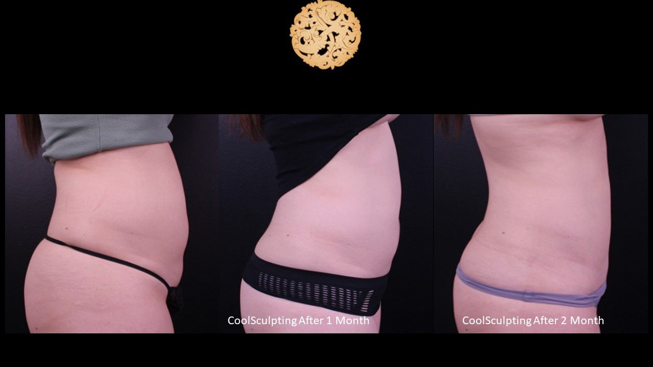 Abdomen Coolsculpting Before & After
