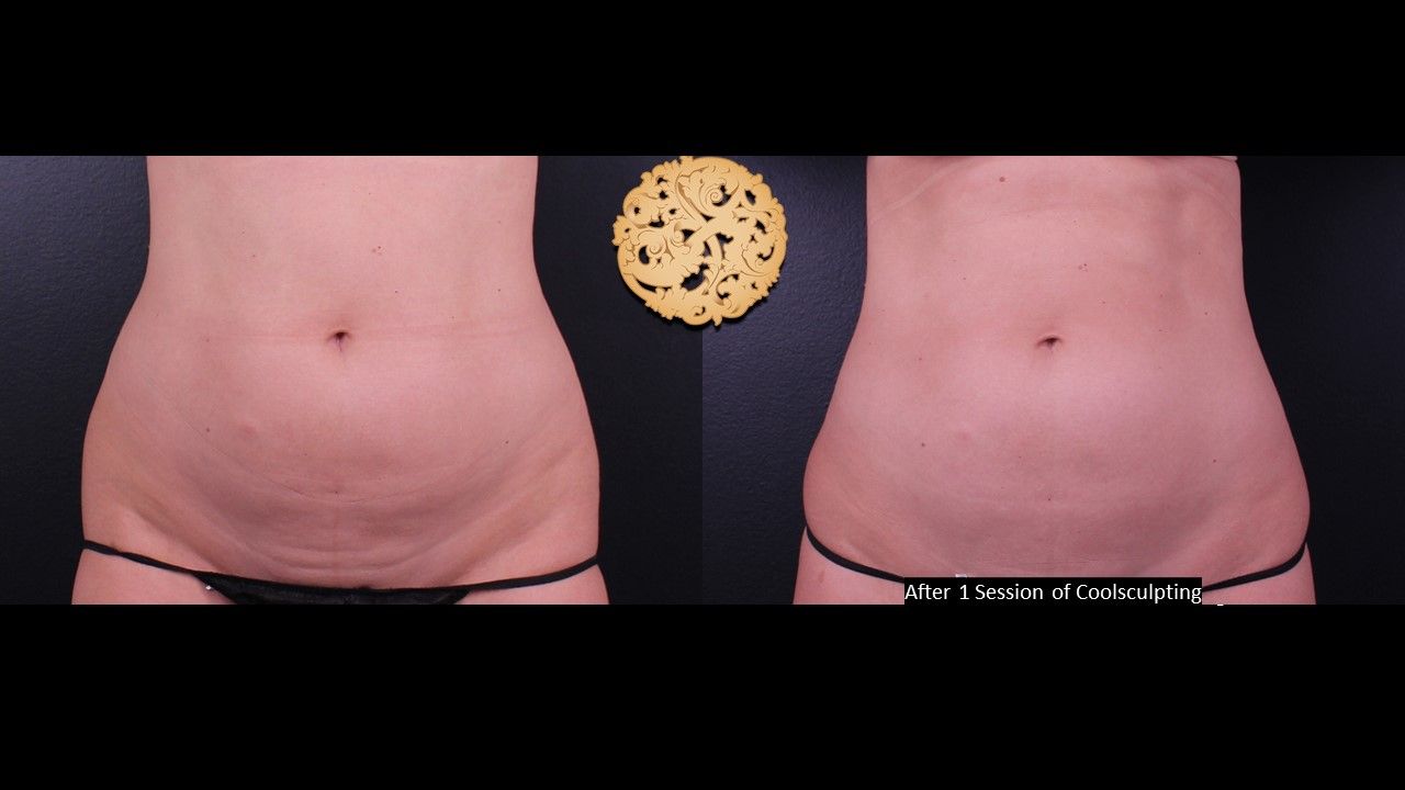 Abdomen Coolsculpting Before & After