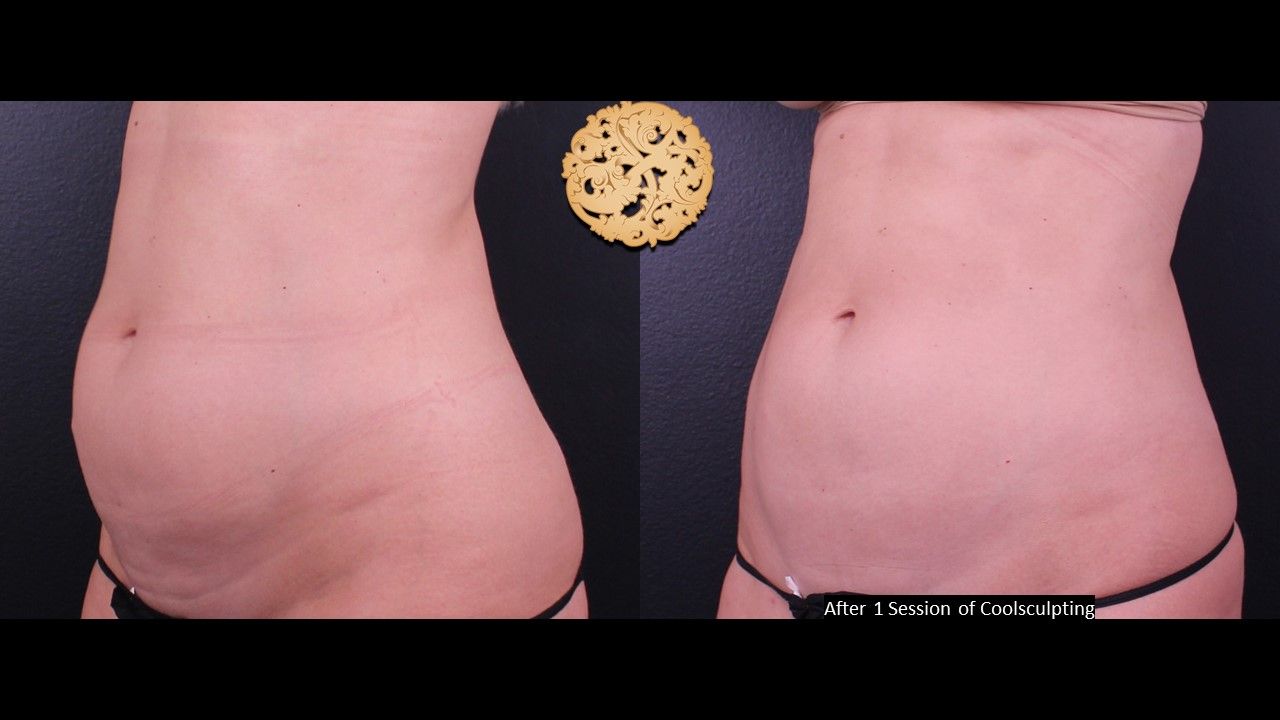 Abdomen Coolsculpting Before & After