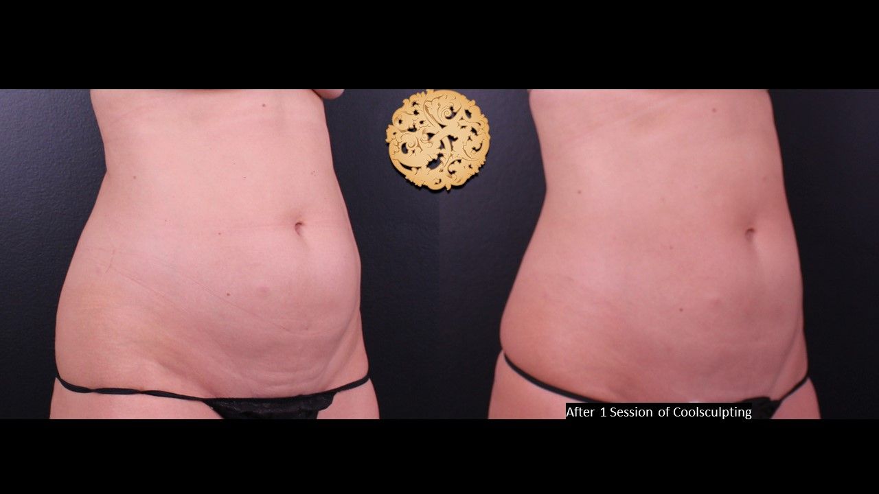 Abdomen Coolsculpting Before & After