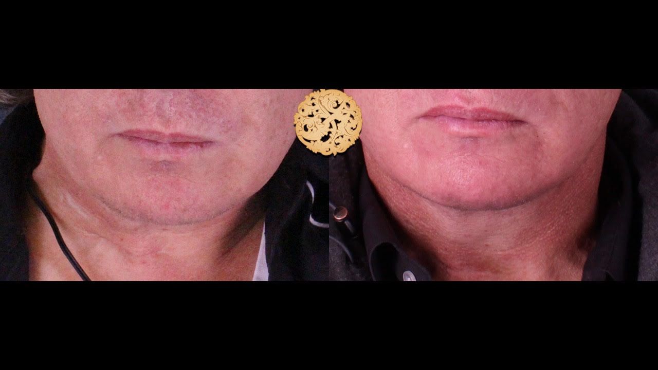 Fat Transfer To Lips Before & After