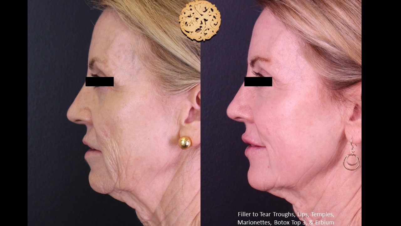Erbium Laser Before & After