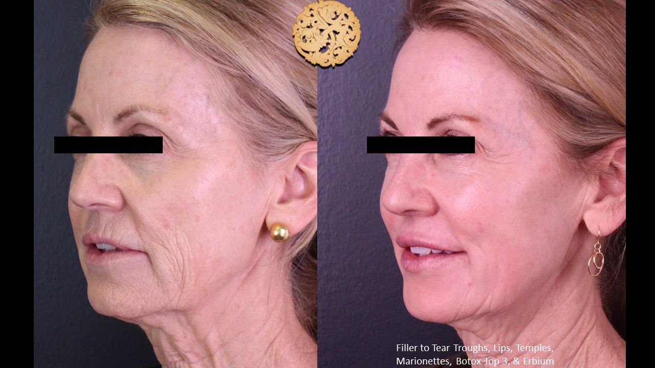 Erbium Laser Before & After