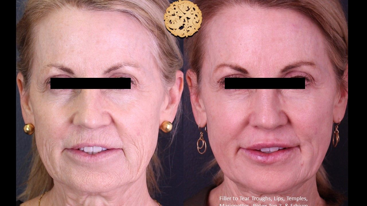 Erbium Laser Before & After