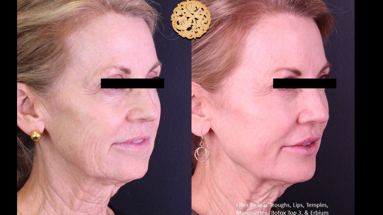 Erbium Laser Before & After