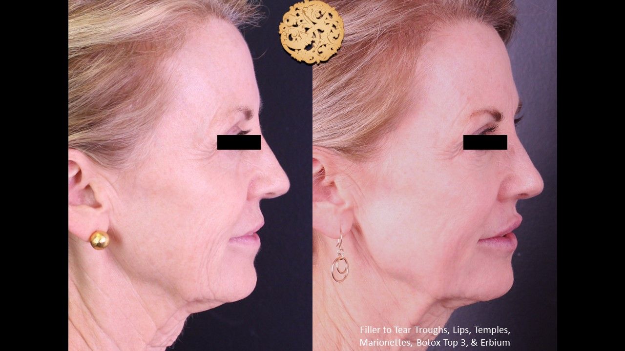 Erbium Laser Before & After