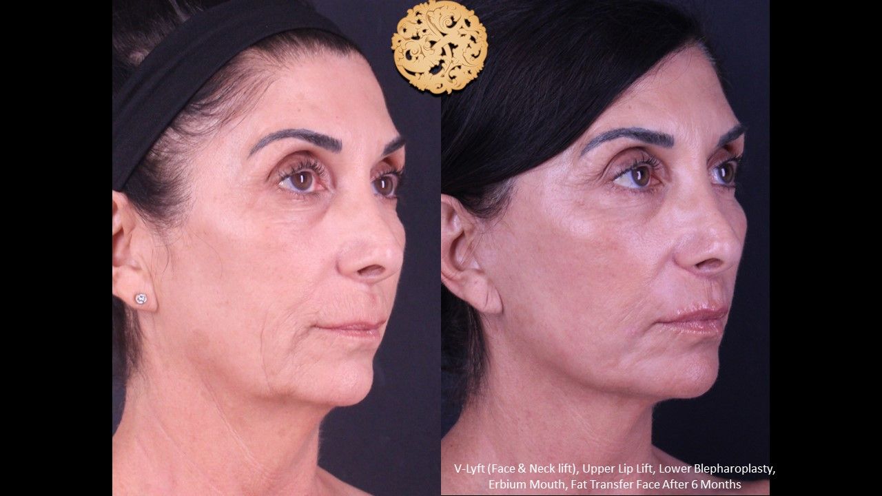 Erbium Laser Before & After