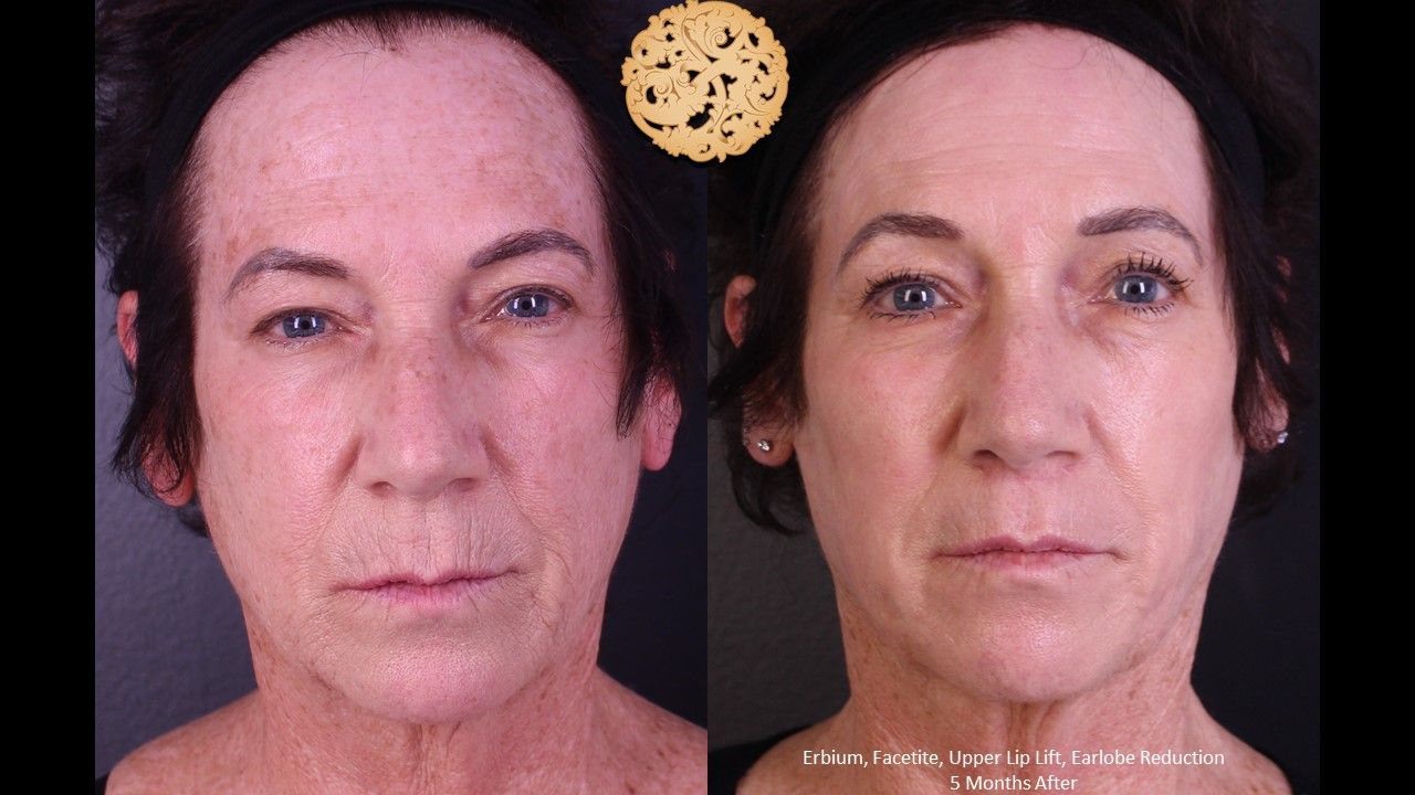 Erbium Laser Before & After