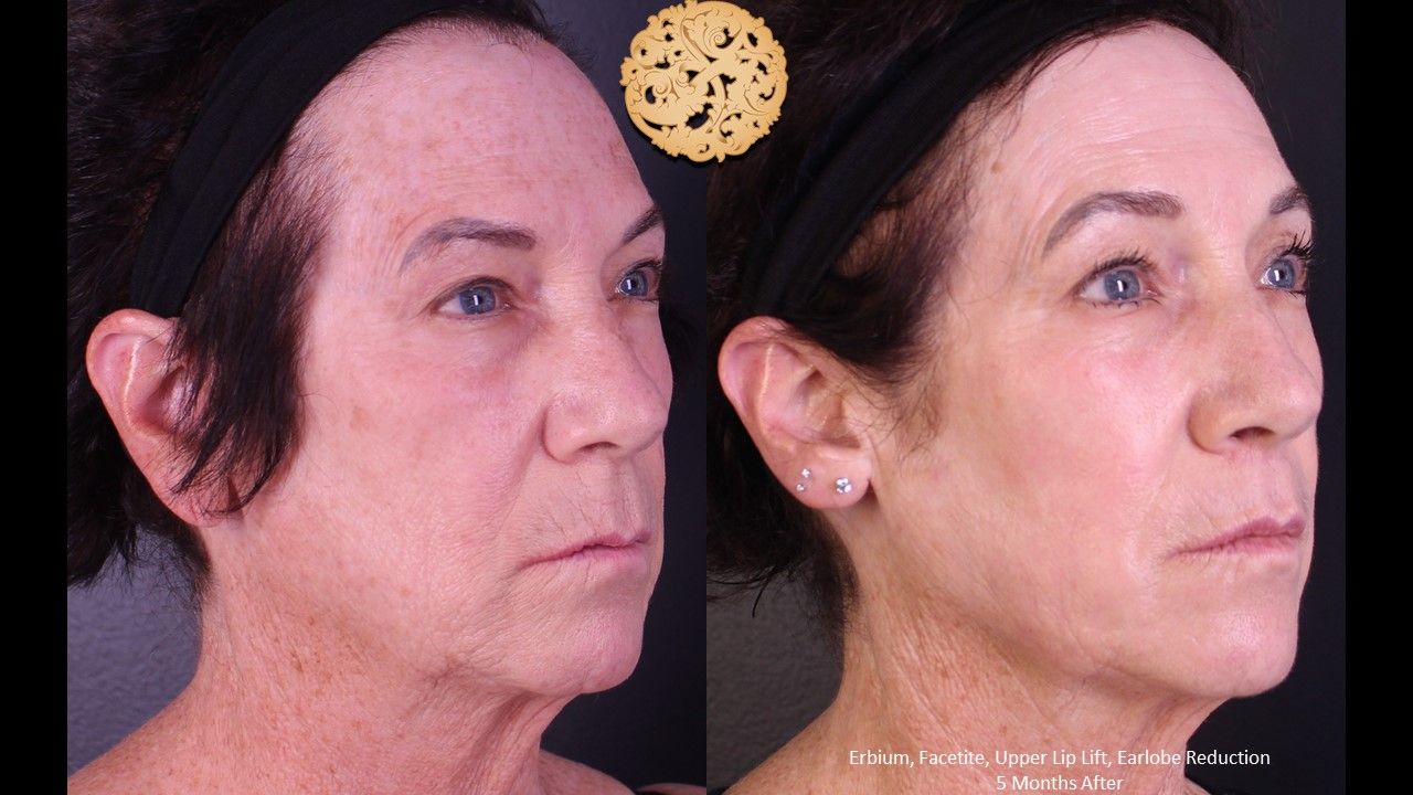 Erbium Laser Before & After