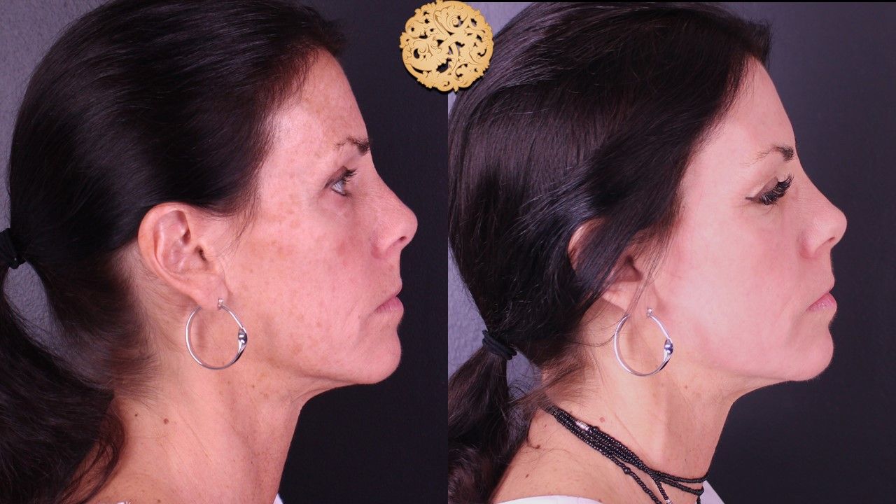 Erbium Laser Before & After