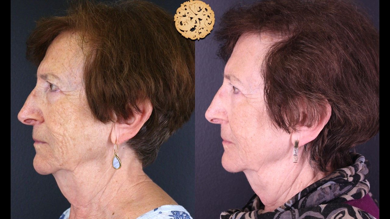 Erbium Laser Before & After