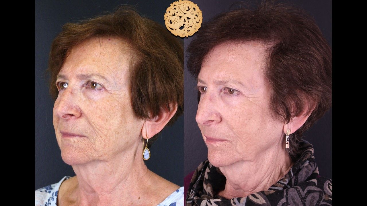 Erbium Laser Before & After