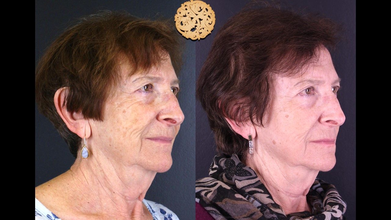 Erbium Laser Before & After