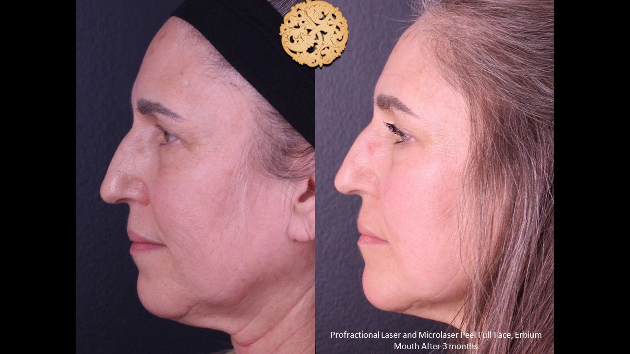 Erbium Laser Before & After