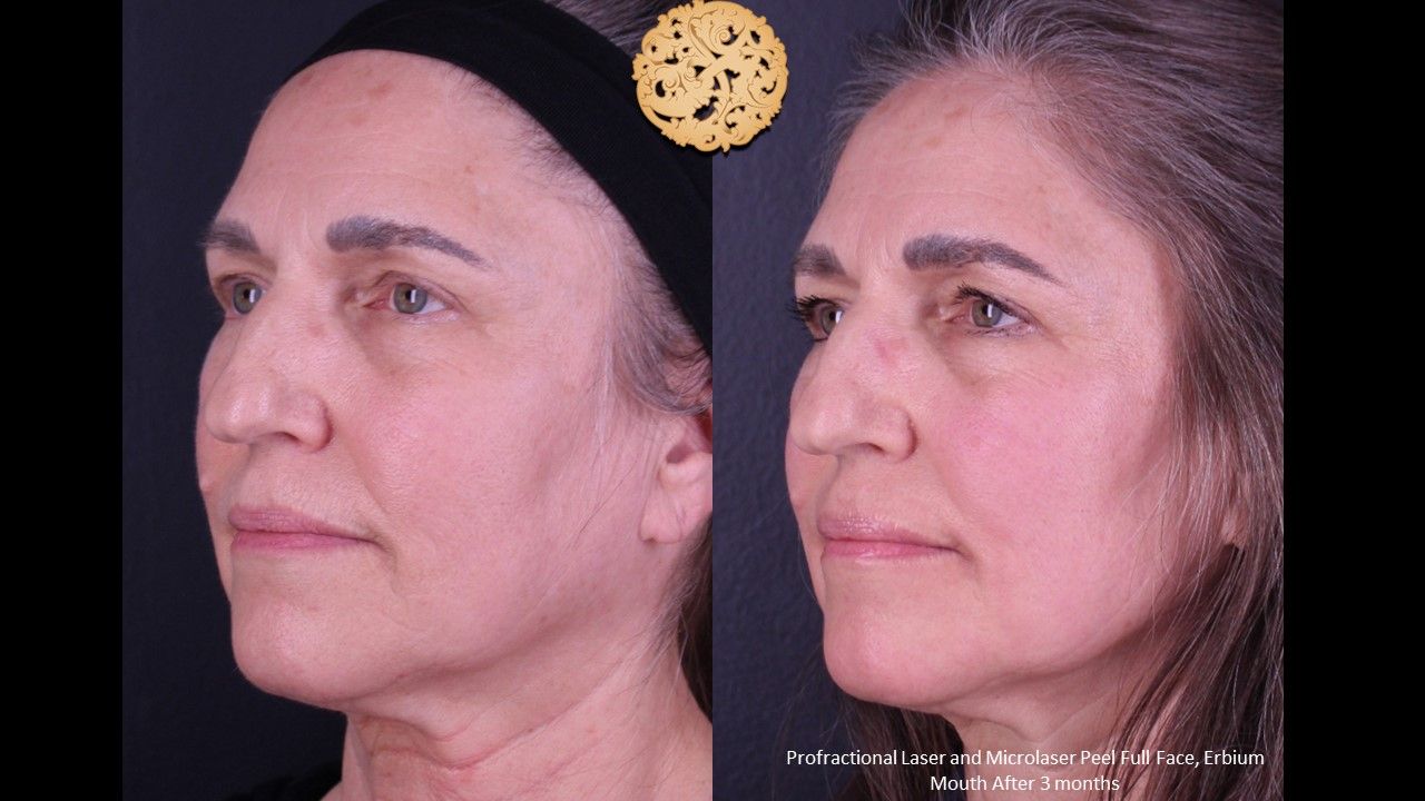 Erbium Laser Before & After