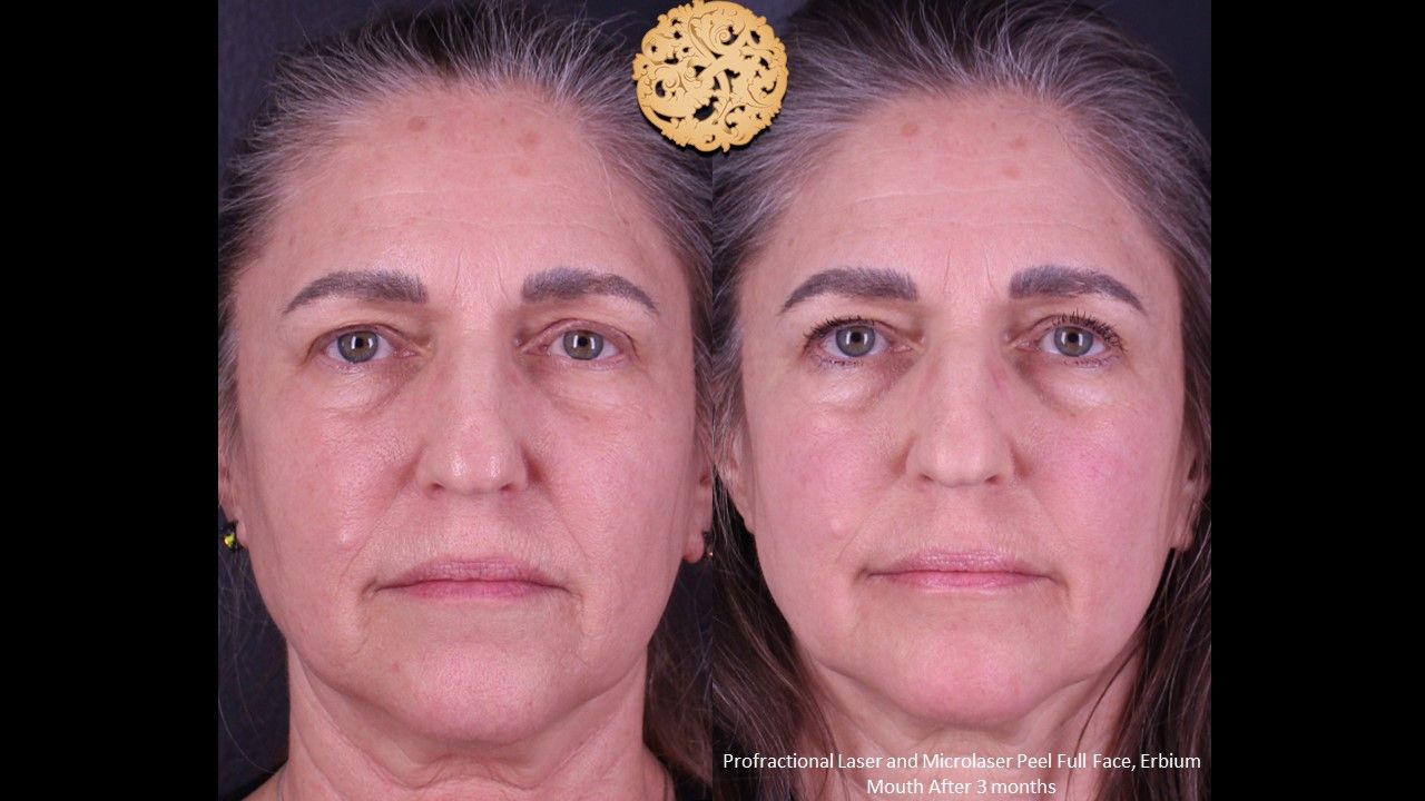 Erbium Laser Before & After