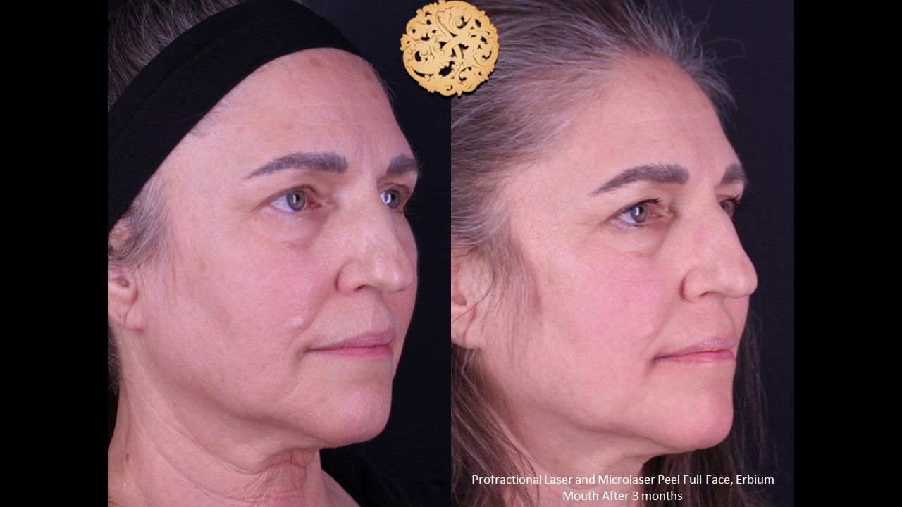 Erbium Laser Before & After