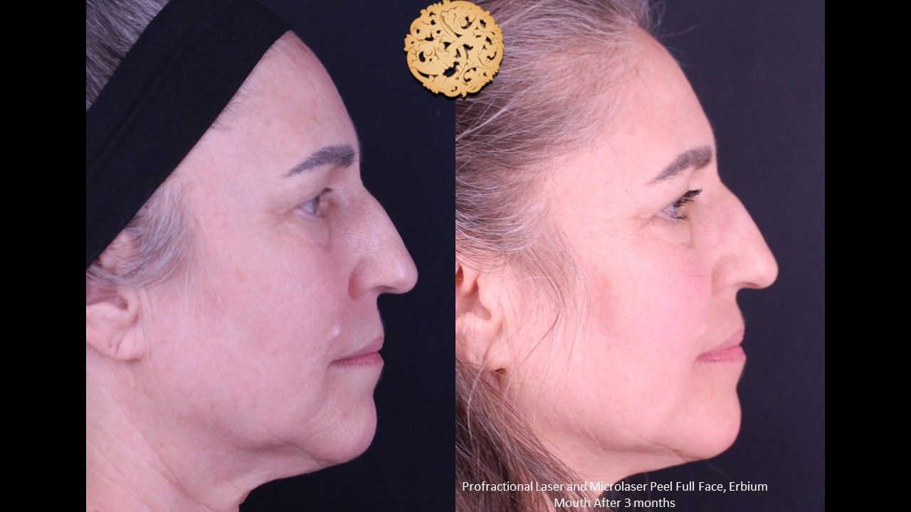 Erbium Laser Before & After