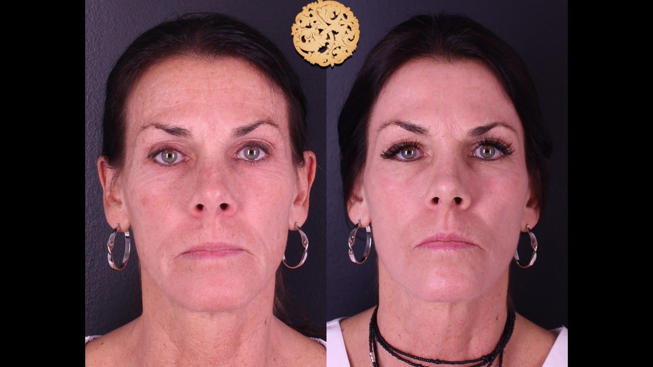 Erbium Laser Before & After