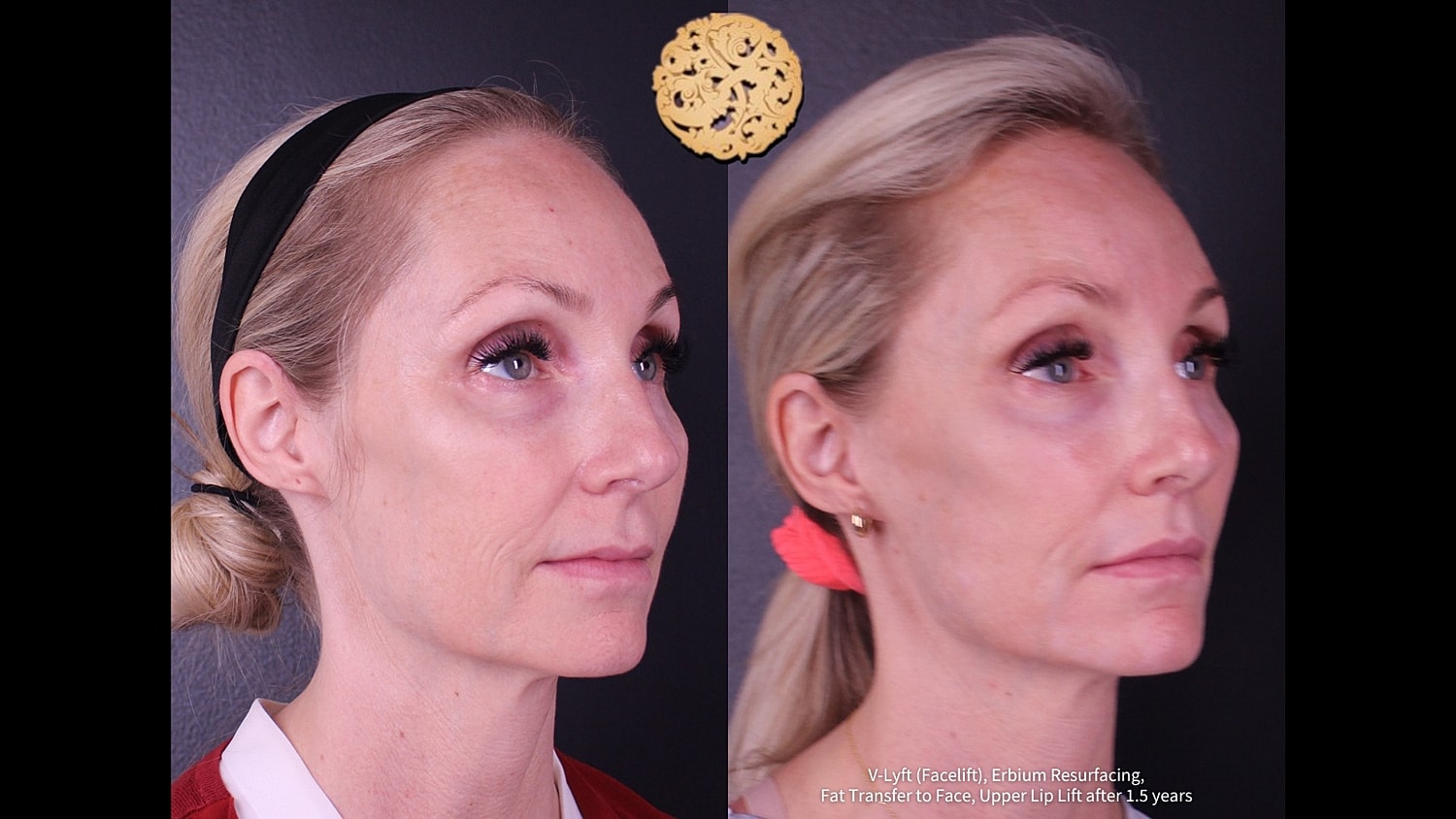 Before and after facial rejuvenation treatment comparison.