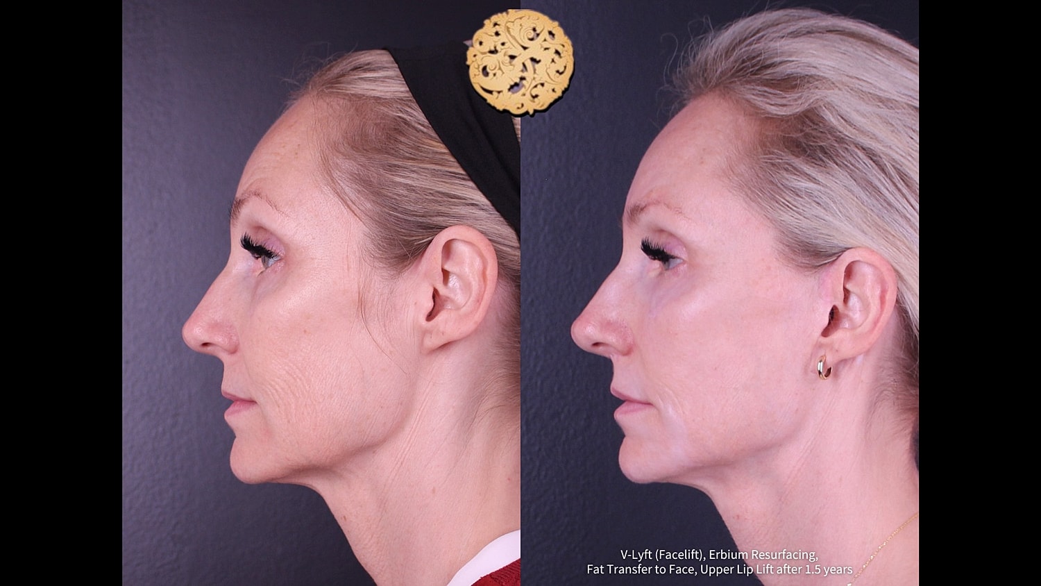 Before and after facial cosmetic procedures comparison.