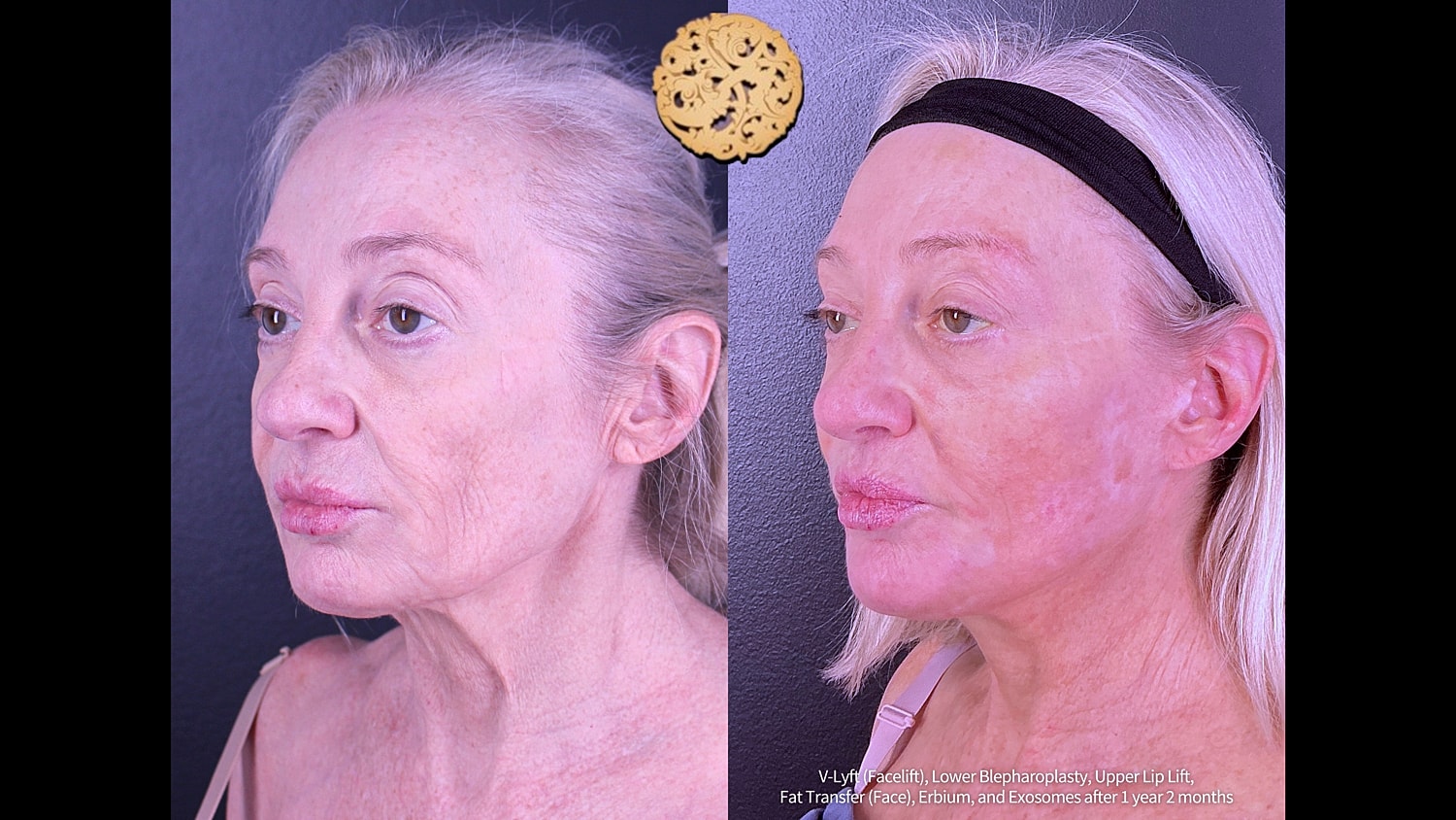 Erbium Laser Before & After