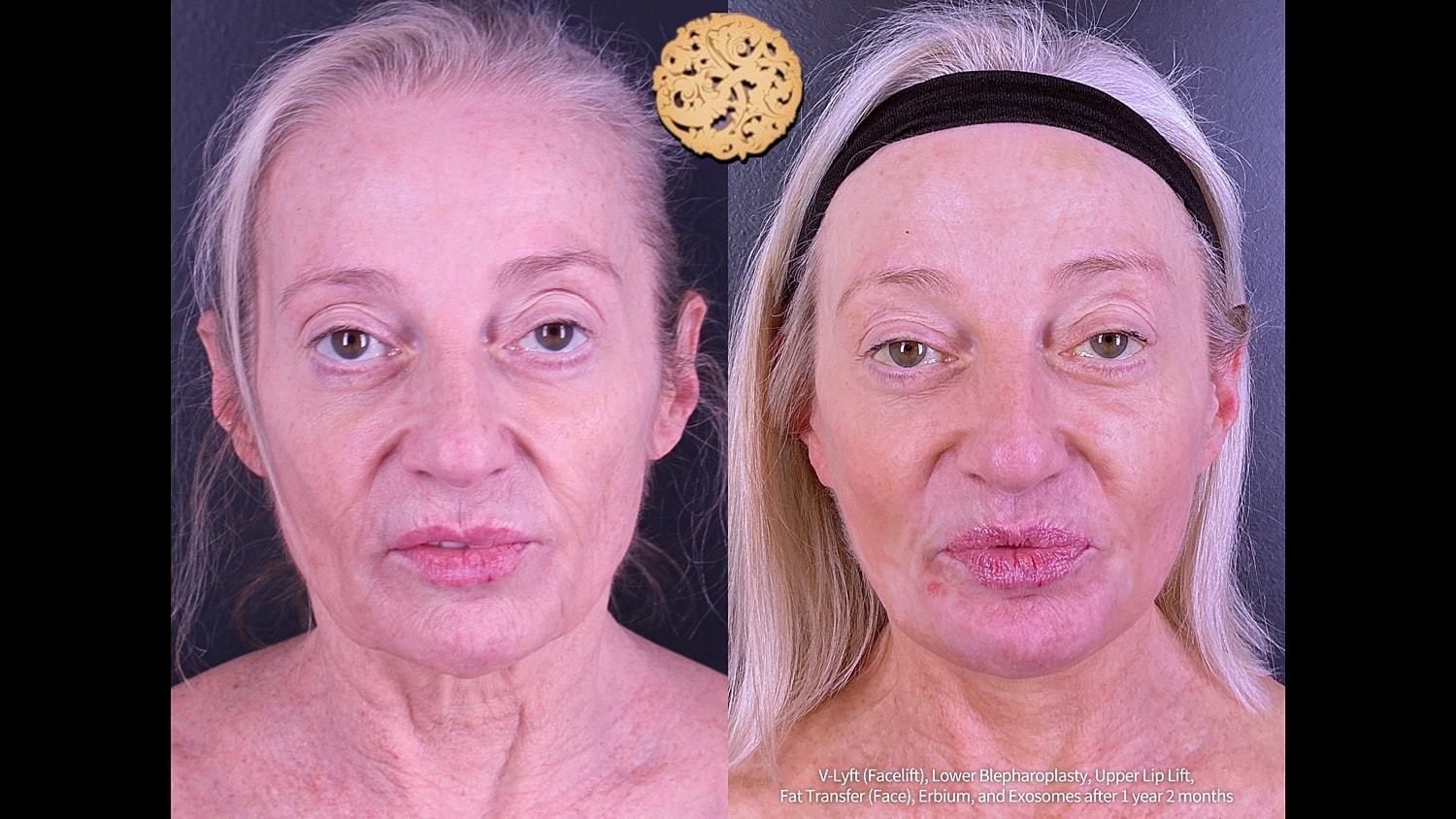Erbium Laser Before & After