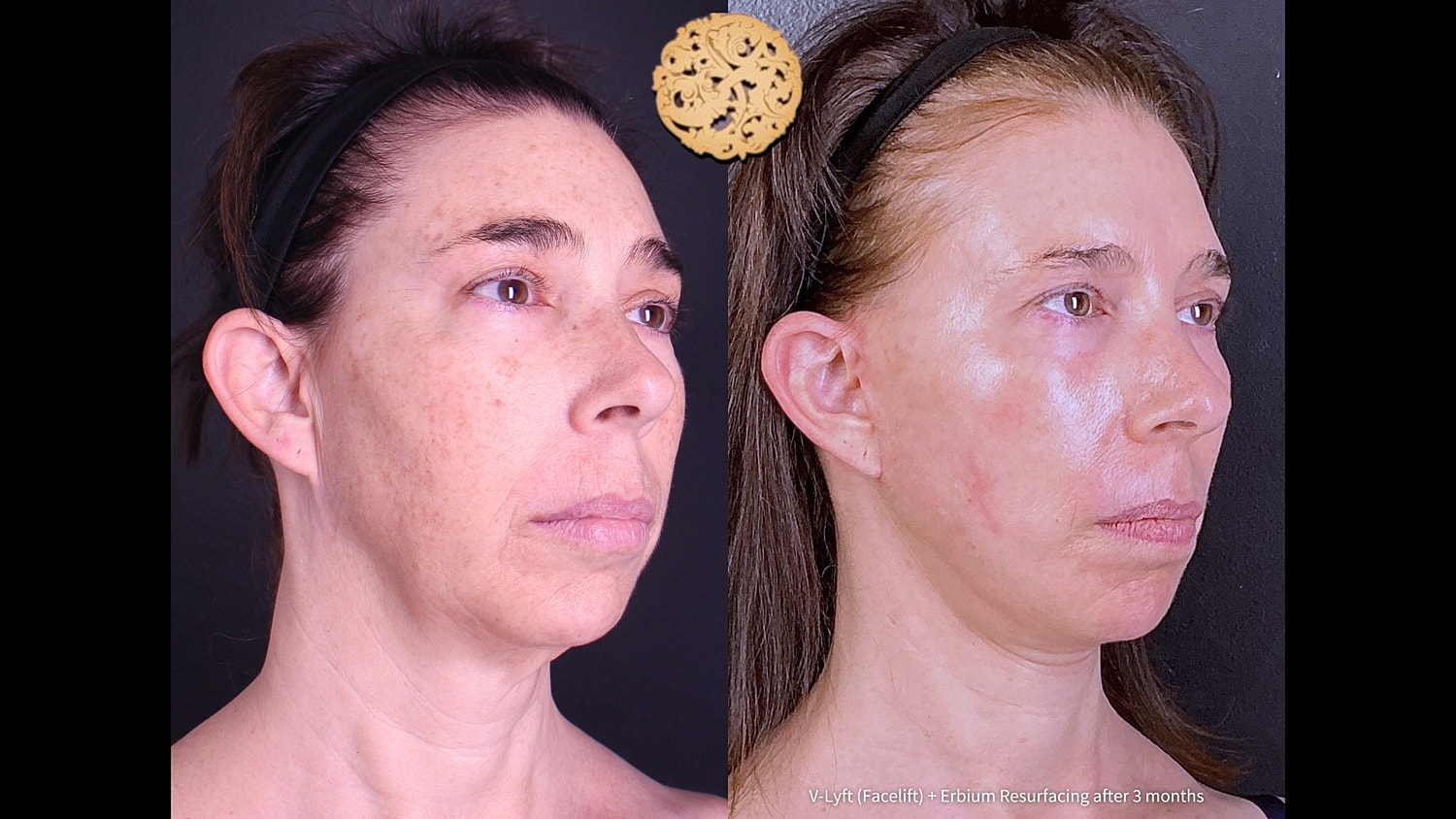 Erbium Laser Before & After