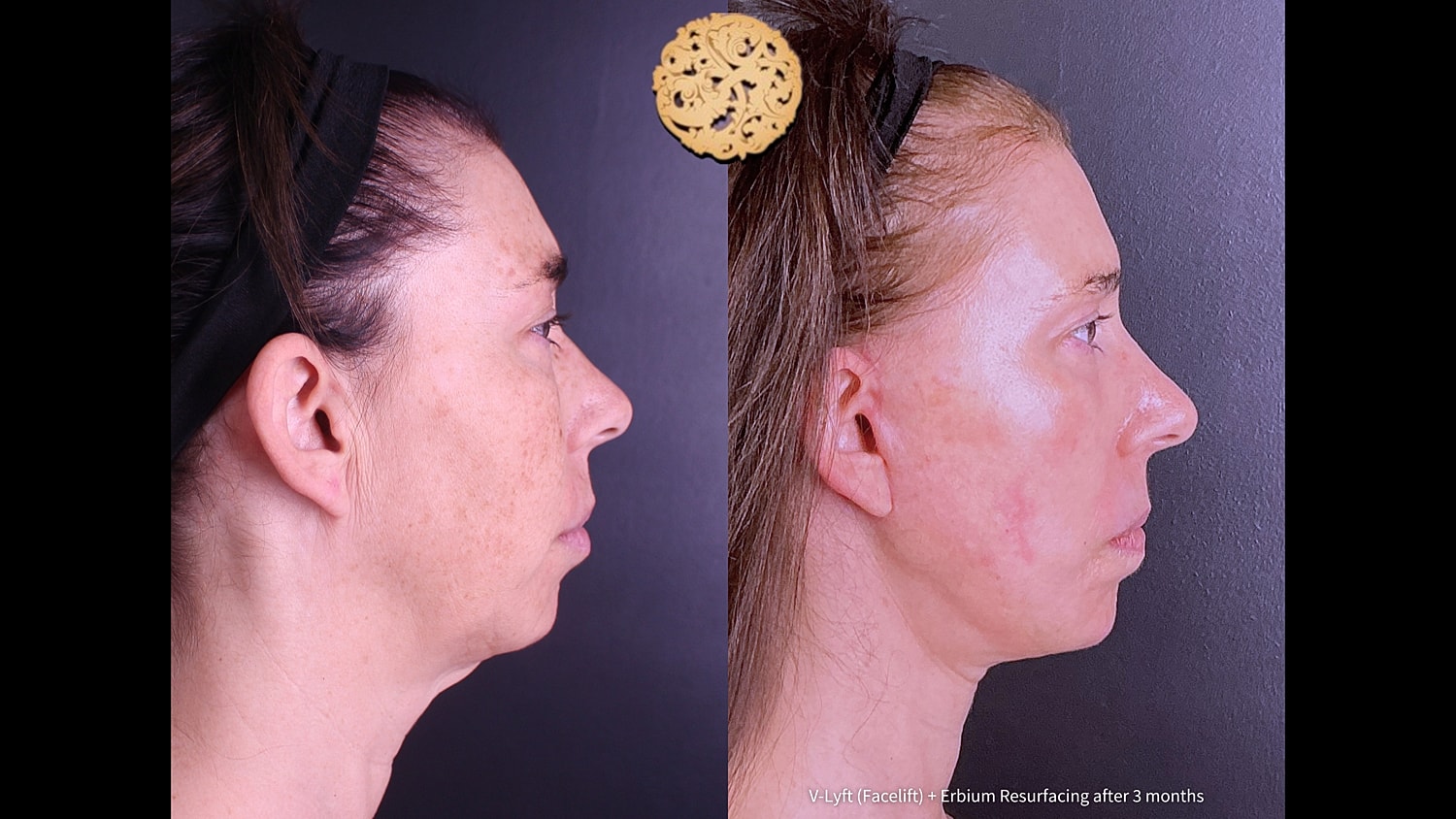 Erbium Laser Before & After