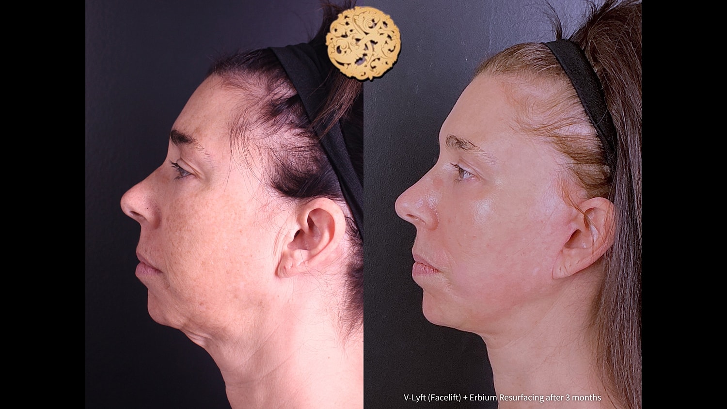 Erbium Laser Before & After